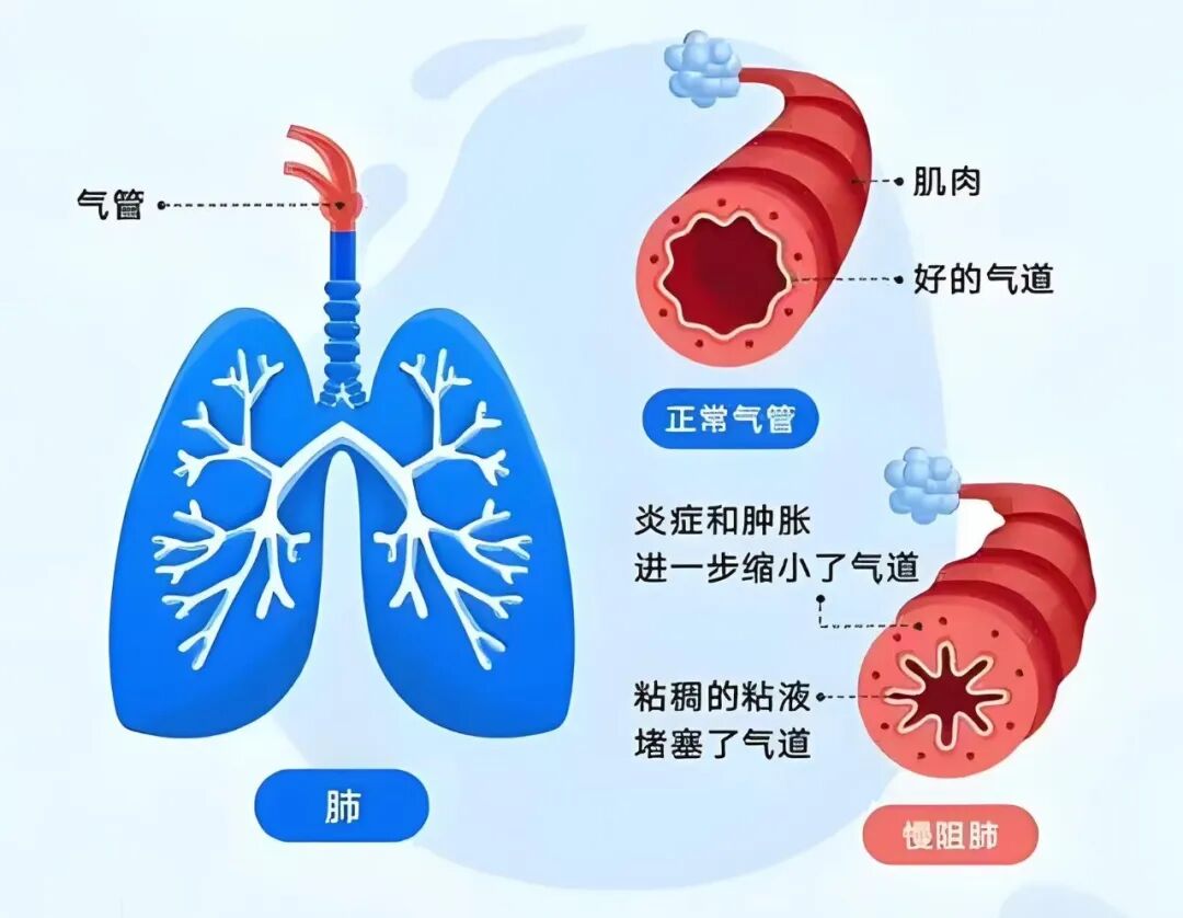 慢阻肺.jpg